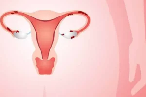 9 حقائق يجب أن تعرفها كل امرأة  عن بطانة الرحم Endometriosis