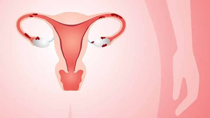 9 حقائق يجب أن تعرفها كل امرأة  عن بطانة الرحم Endometriosis