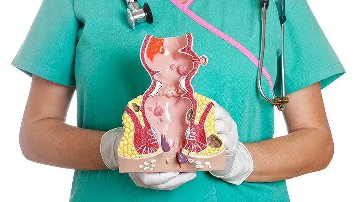 علاج البواسير