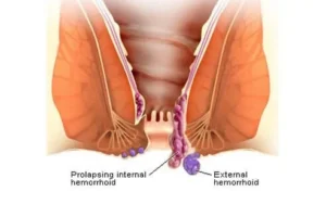 دليل البواسير الشامل: الأعراض، الأسباب، وطرق الوقاية والعلاج المنزلي