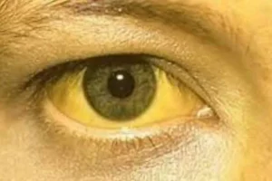 أعراض اليرقان وطرق علاجه