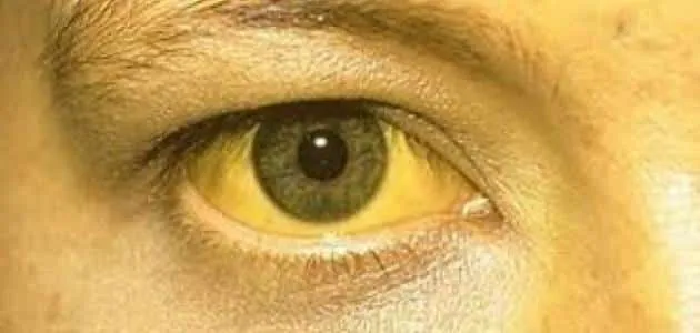 أعراض مرض اليرقان وأفضل طرق علاجه