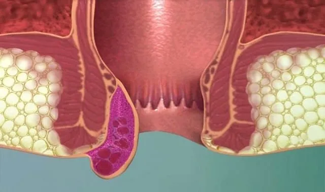 علاج البواسير , أسباب البواسير وأعراضها