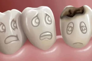 علاج تسوس الأسنان وطرق علاجه