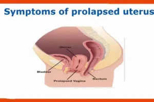 هبوط الرحم أسباب وعلاج