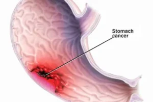أعراض سرطان المعدة أسبابه وعلاجه