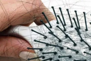 علاج تساقط الشعر