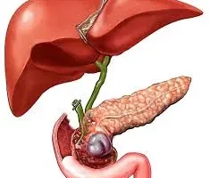 التهاب المرارة أعراض و طرق علاجه