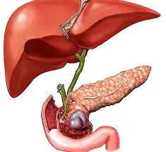 التهاب المرارة أعراض و طرق علاجه