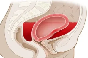 النزيف المهبلي أسبابه وعلاجه