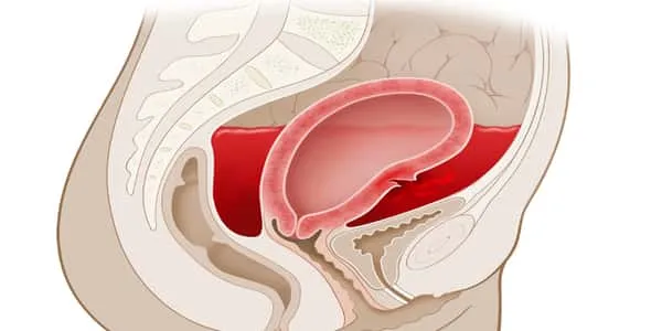 النزيف المهبلي أسبابه وعلاجه