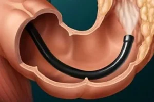 كيفية تنظيف القولون بطرق طبيعية