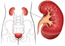 حصوات الكلي أسباب تكونها وطرق علاجها