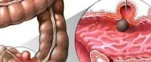داء الرتوج في القولون أعراضه وعلاجه