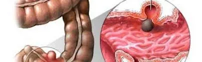 داء الرتوج في القولون أعراضه وعلاجه