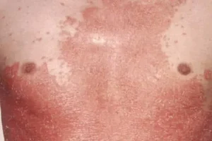 الصدفية أسبابها و كيفية علاجها