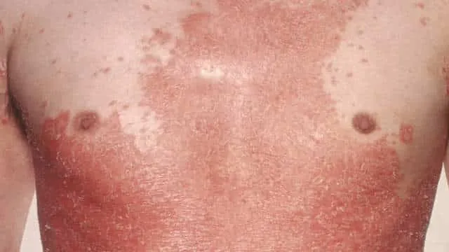 الصدفية أسبابها و كيفية علاجها