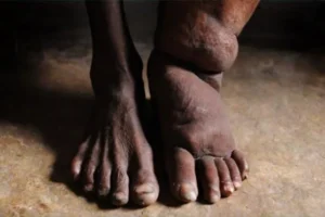 أعراض داء الفيل و علاجه وطرق الوقاية