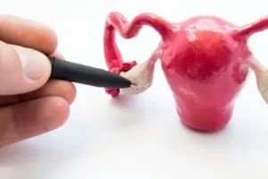 تكيس المبايض أعراضه وعلاجه