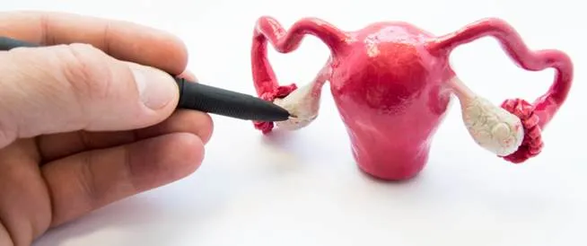 تكيس المبايض أعراضه وعلاجه