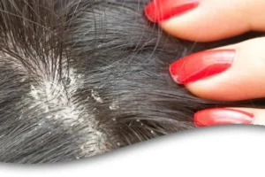 كيفية التخلص من قشرة الشعر