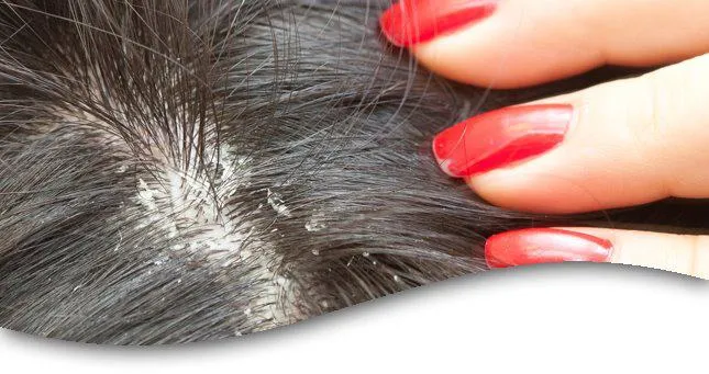 كيفية التخلص من قشرة الشعر