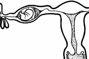 أعراض الحمل خارج الرحم