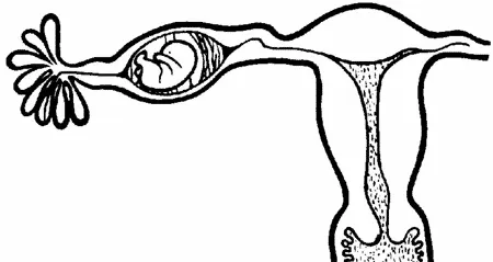 الحمل خارج الرحم