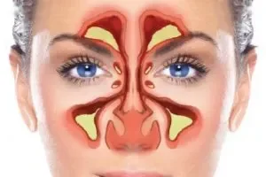 علاج الجيوب الأنفية