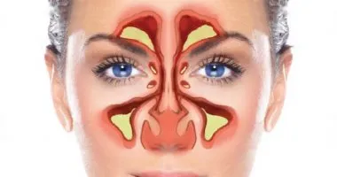 علاج الجيوب الأنفية
