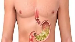 قرحة المعدة