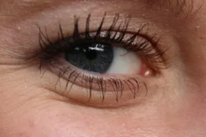 أمراض العيون وعلاجها بالأعشاب