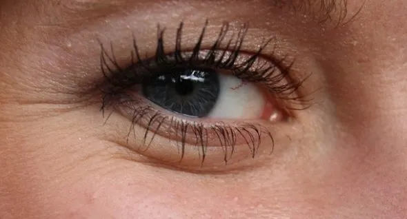 أمراض العيون وعلاجها بالأعشاب