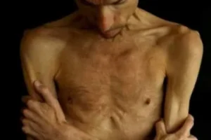 النحافة المفرطة