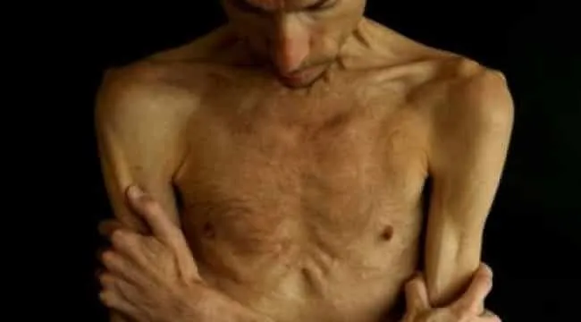 النحافة المفرطة